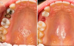 مقایسه وضعیت دهان و دندان قبل و بعد از کشیدن دندان در سبزوار