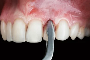 تصویر آموزشی کشیدن دندان در سبزوار برای آشنایی بیماران با مراحل درمان دندانی.