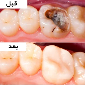 دندان پس از پر کردن با کامپوزیت، بازسازی طبیعی و هماهنگ با دندان‌های مجاور