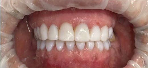 عکس بعد از اجرا روکش توسط دکتر فائزه استاجی