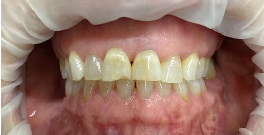 تصویر قبل از روکش در مطب دکتر فائزه استاجی2