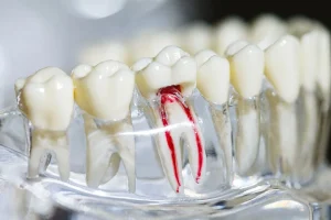 درمان ریشه دندان با دستگاه  مدرن در مطب دکتر فائزه استاجی