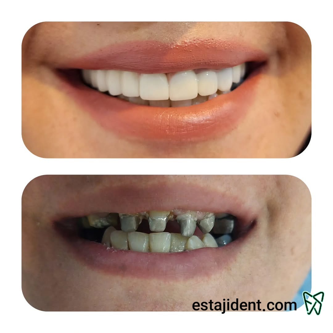 قبل و بعد از روکش دندان سرامیکی – بازسازی فرم و زیبایی دندان