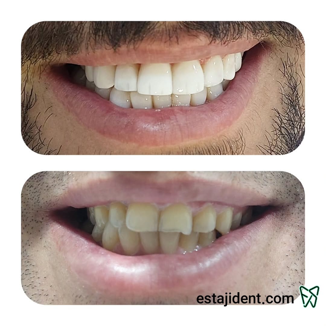 قبل و بعد از کامپوزیت دندان – اصلاح طرح لبخند و ترمیم زیبایی