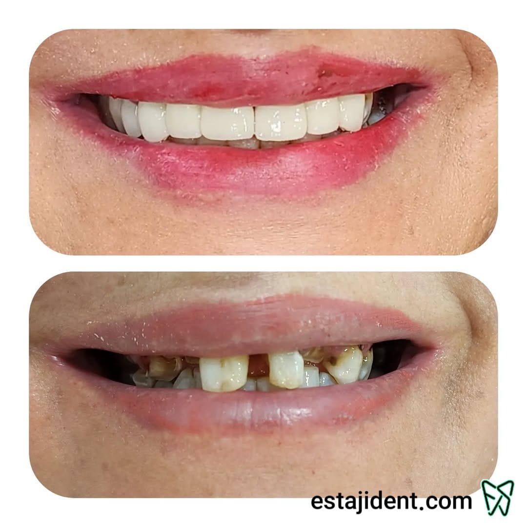 تاثیر روکش دندان بر زیبایی لبخند – قبل و بعد