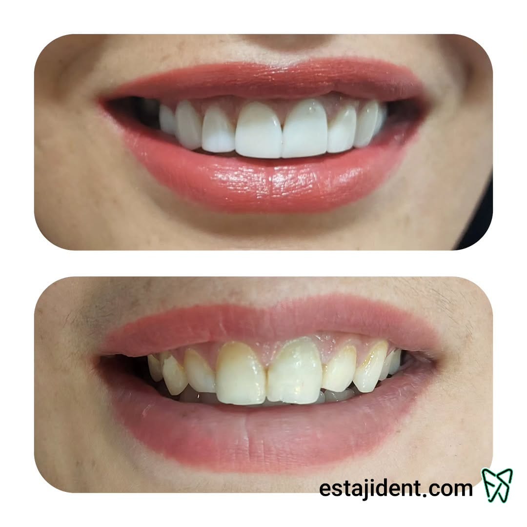 قبل و بعد از روکش کامل دندان – اصلاح طرح لبخند