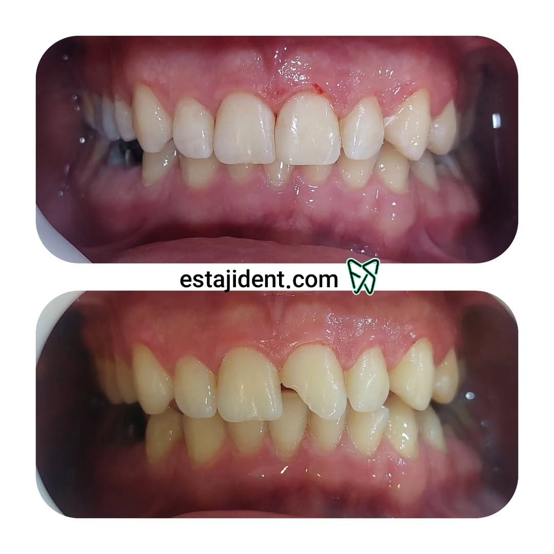 قبل و بعد از روکش زیبایی دندان – لبخند طبیعی و سفید