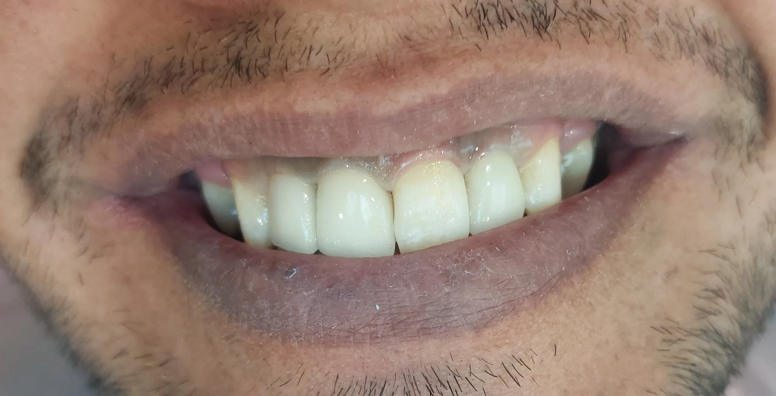 تصویر بعد از روکش در مطب دکتر فائزه استاجی