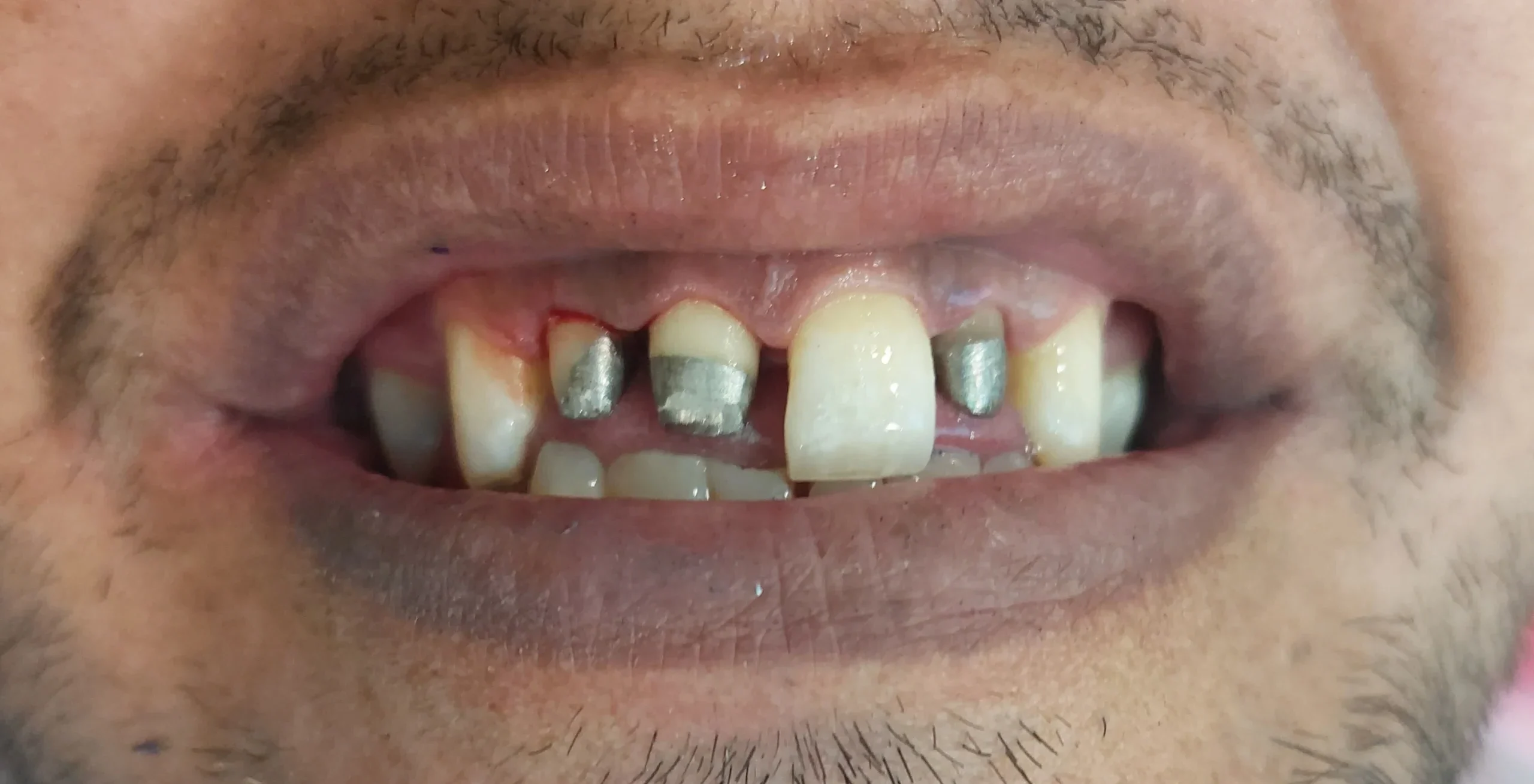 تصویر قبل از روکش در مطب دکتر فائزه استاجی