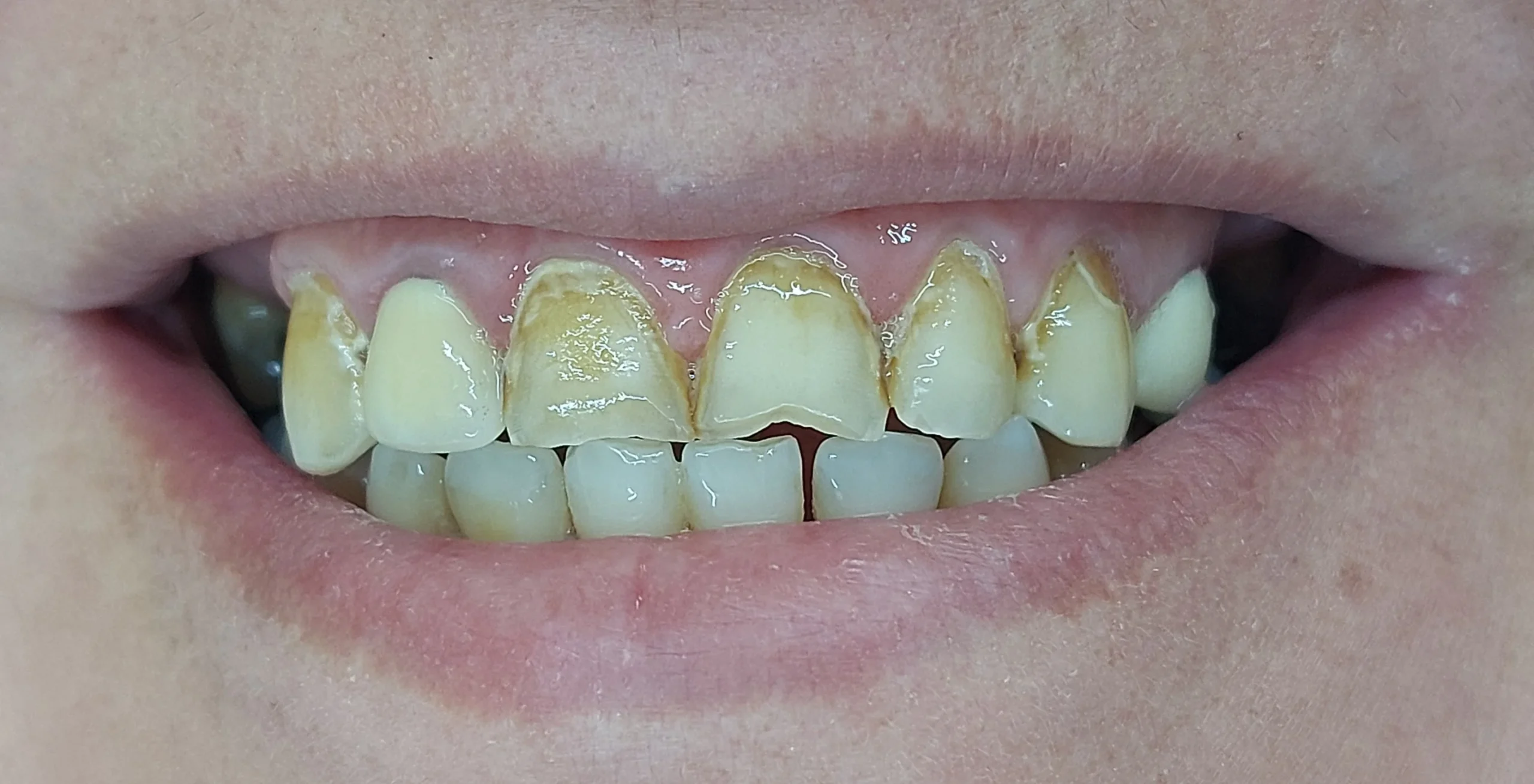 تصویر قبل در مطب دکتر فائزه استاجی2