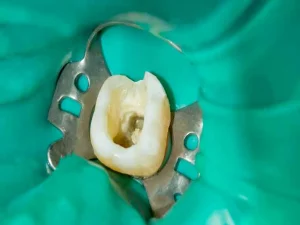 تصویر بعد از عصب‌کشی دندان با ترمیم کامل و طبیعی ت.سط درکتر فائزه استاجی سبزوار تهران گرگان