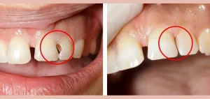 عکس قبل و بعد پر کردن دندان با کامپوزیت، بازسازی طبیعی دندان‌های پوسیده