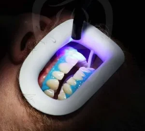 بلیچینگ 6 درمان بلیچینگ برای رفع زردی و لکههای دندان